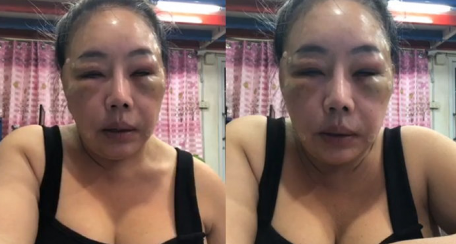 "ลีน่าจัง" โชว์สภาพหน้าบวมเป่ง หลังฉีดไขมันรอบดวงตา 